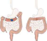 Síntomas de cáncer de colon: primeros, iniciales y avanzado