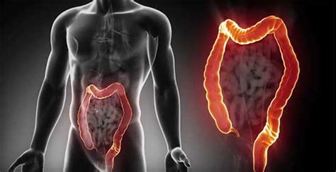 Síntomas de cáncer de colon y detección   infotratamiento