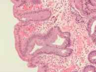 Síntomas de cáncer de esófago  esofágico : primeros ...