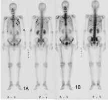 Síntomas de cáncer de huesos  óseo : primeros, iniciales y ...