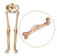 Síntomas de cáncer de huesos  óseo : primeros, iniciales y ...