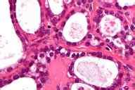 Síntomas de cáncer de ovario: primeros, iniciales y avanzado