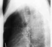 Síntomas de cáncer de pulmón  pulmonar : primeros ...