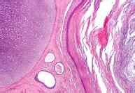 Síntomas de cáncer de testículo  testicular : primeros ...
