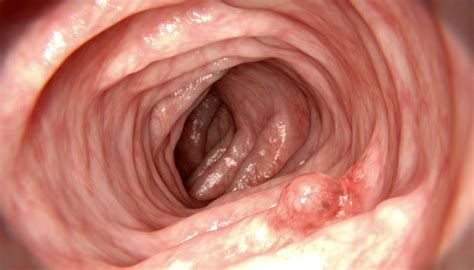 Sintomas de câncer no intestino: fadiga, falta de ar ...