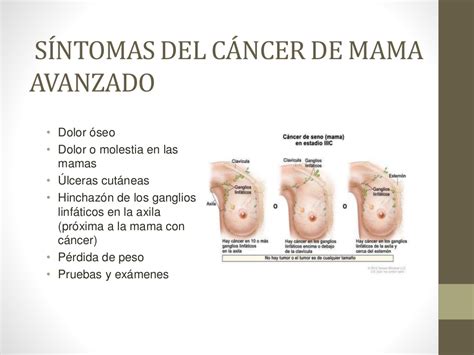 Sintomas De Cancer Pictures to Pin on Pinterest   ThePinsta