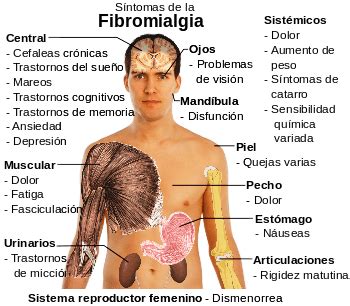 Síntomas de fibromialgia: enfermedad dolorosa   La Guía de ...