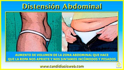Síntomas de la candidiasis   Distensión abdominal