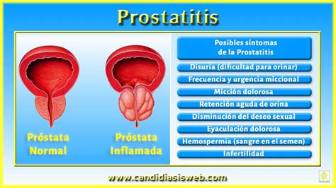 Síntomas de la candidiasis   Prostatitis