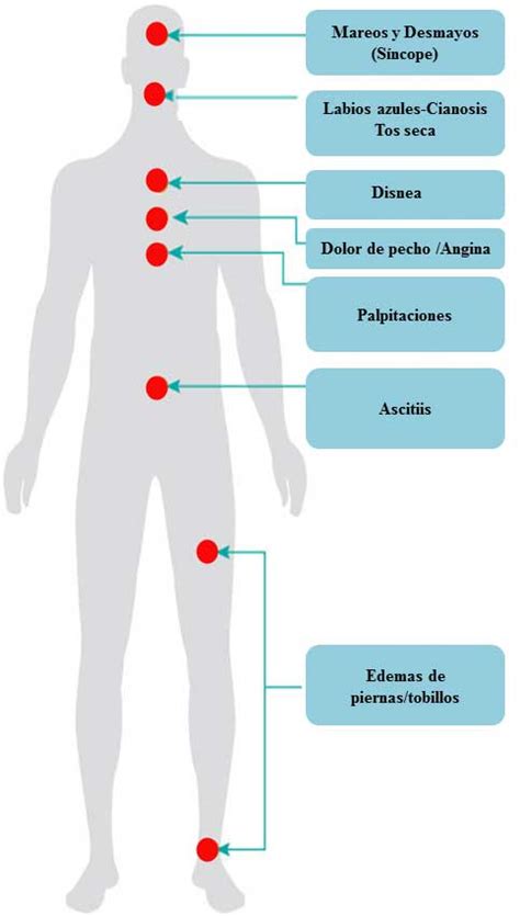 SINTOMAS DE LA HIPERTENSION PULMONAR – Hipertension ...