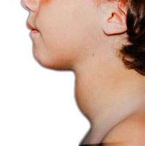 Síntomas de la tiroides | Bienestar natural