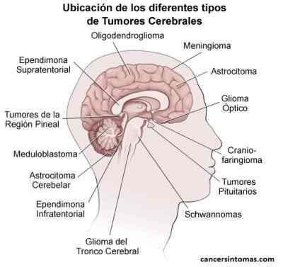 Síntomas de tumor cerebral  cáncer de cerebro