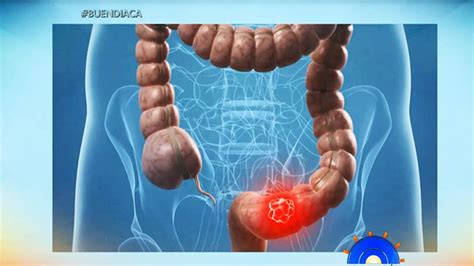 Síntomas del cáncer de páncreas – TEN | HD