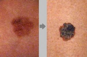 Síntomas del cáncer de piel