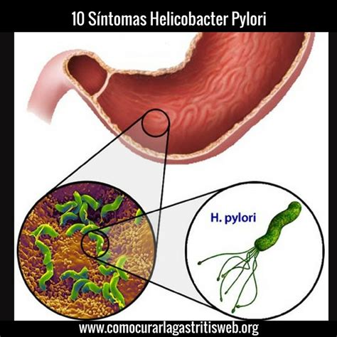 Síntomas del Helicobacter Pylori | Bacteria Helicobacter ...