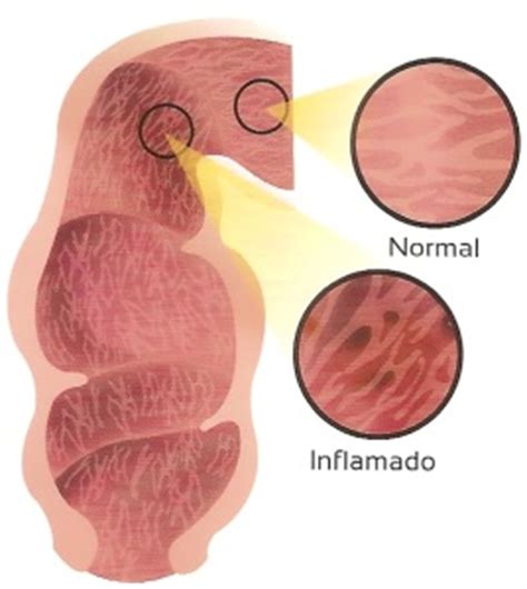 Síntomas del Síndrome de Intestino Irritable | Dr Isidoro ...