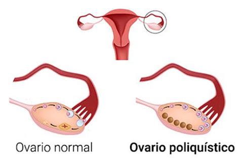 Síntomas del síndrome de ovario poliquístico   Salud al día