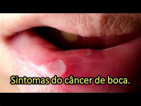 Sintomas do câncer de boca   YouTube