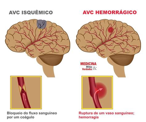 Sintomas e complicações do derrame: AVC isquêmico ou ...