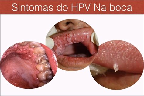 Sintomas e Tratamento do HPV na boca