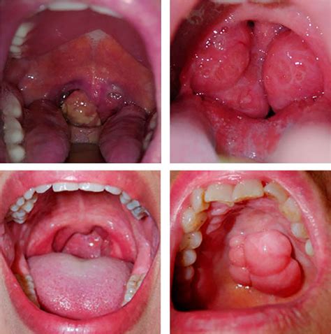 Síntomas iniciales en el cáncer de garganta o laringe ...