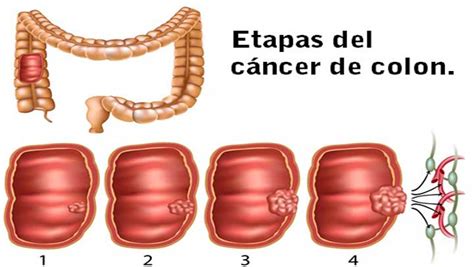 Síntomas que debes saber para detectar un cáncer de colon ...