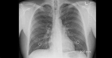 Síntomas y tratamiento del cáncer de pulmón