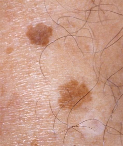 Skin Cancer as related to Cutaneous skin tags   Pictures
