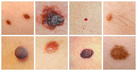 Skin Cancer   Causes, Symptoms and Treatment | Health Care ...