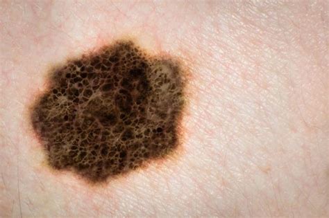 Skin cancer: how effective are smartphone apps for early ...