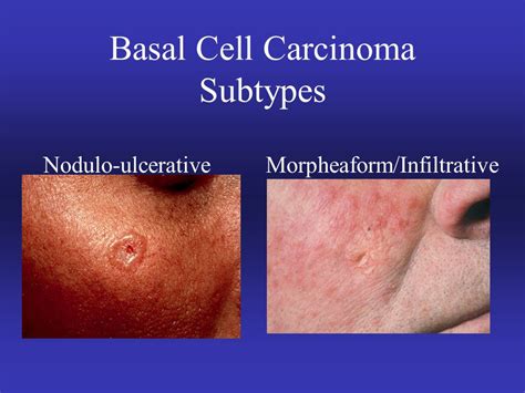 Skin Cancer Incidence Over 1 million new cases of BCC ...
