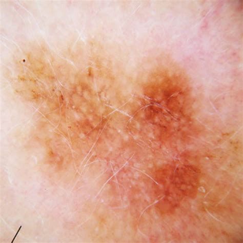 Skin Cancer | Melanoma | Signs and Symptoms   Skin cancer ...
