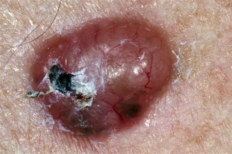 Skin cancer  non melanoma    NHS
