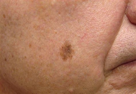 Skin Cancer on Face Pictures – 33 Photos & Images ...