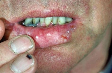 skin cancer on lip Health Pictures of Cancer   Pictures ...