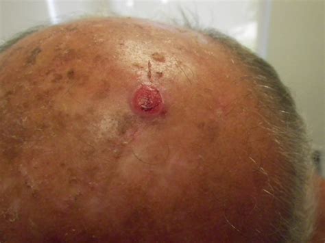 Skin Cancer on Scalp Pictures – 20 Photos & Images ...