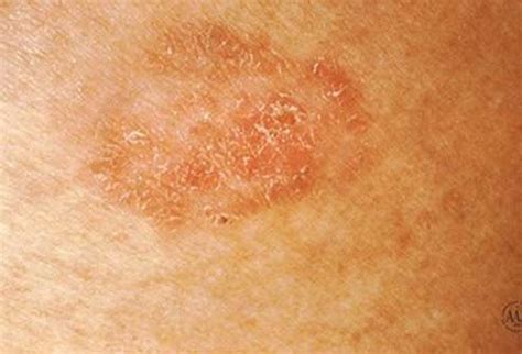 skin cancer pictures early stages | Bowen’s disease is ...