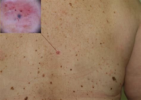 Skin Cancer Pictures Moles Symptoms Signs on Face Spots on ...