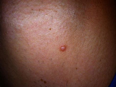 Skin Cancer Pictures Moles Symptoms Signs on Face Spots on ...