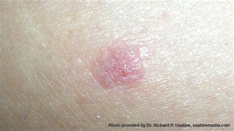 Skin Cancer Pictures & Photos | Pictures of Skin Cancer