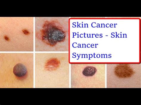 Skin Cancer Pictures | Pictures Of Skin Cancer Symptoms ...
