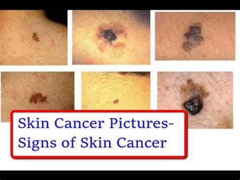 Skin cancer pictures – buzzpls.Com