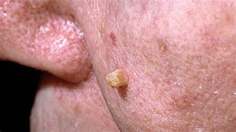 Skin Cancer Rash: Itchiness and Symptoms