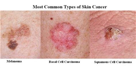 Skin Cancer – Know the Facts   Aspire Health Corp