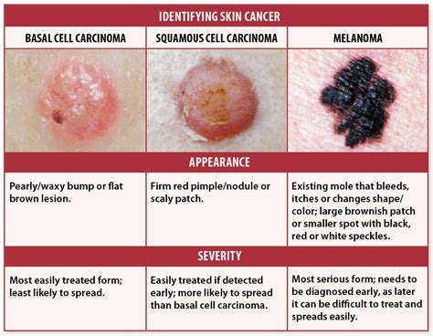 Skin Cancer Signs? Self Checks May Help You Avoid Deadly ...