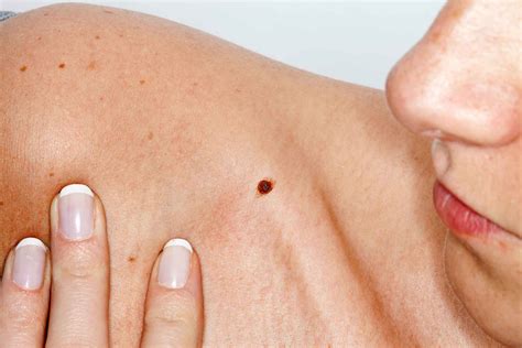 Skin Cancer Symptoms: How to Check for Moles | Reader’s Digest