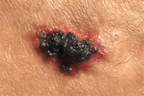 Skin Cancer Symptoms: How to Check for Moles | Reader’s Digest