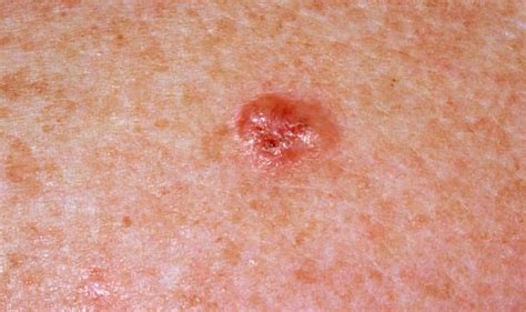Skin cancer symptoms: Mole screening now available at ...