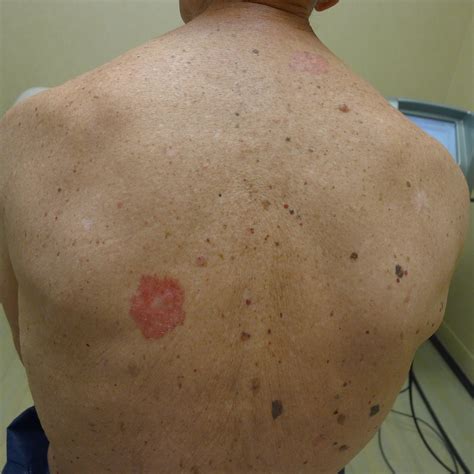 Skin Cancer, Symptoms, Pictures, Photos, Types, Signs ...