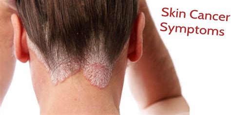 Skin cancer: Symptoms & Preventions  khoobsurati